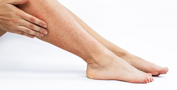 Cómo evitar la piel irritada por depilación? | ShinnySkin