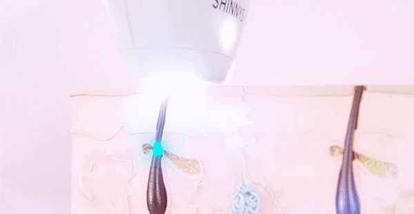 Depilación IPL | ShinnySkin