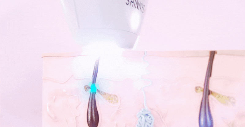 Depilación IPL | ShinnySkin